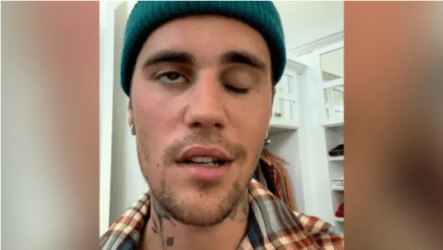 Justin Bieber paralysé de la moitié du visage | Sunday Times